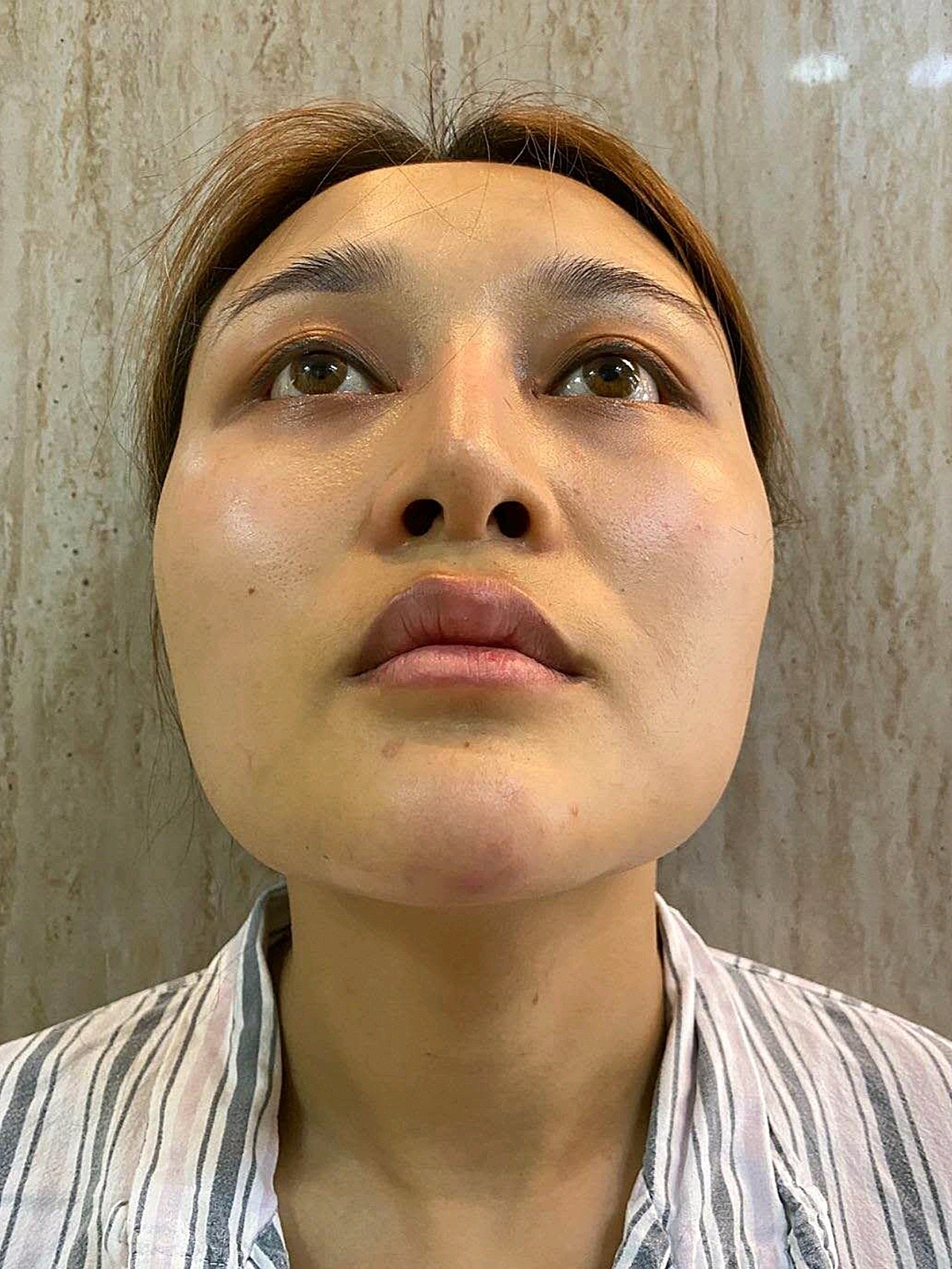 本人做的项目:颧骨下降颧弓内推 下颌角长曲线