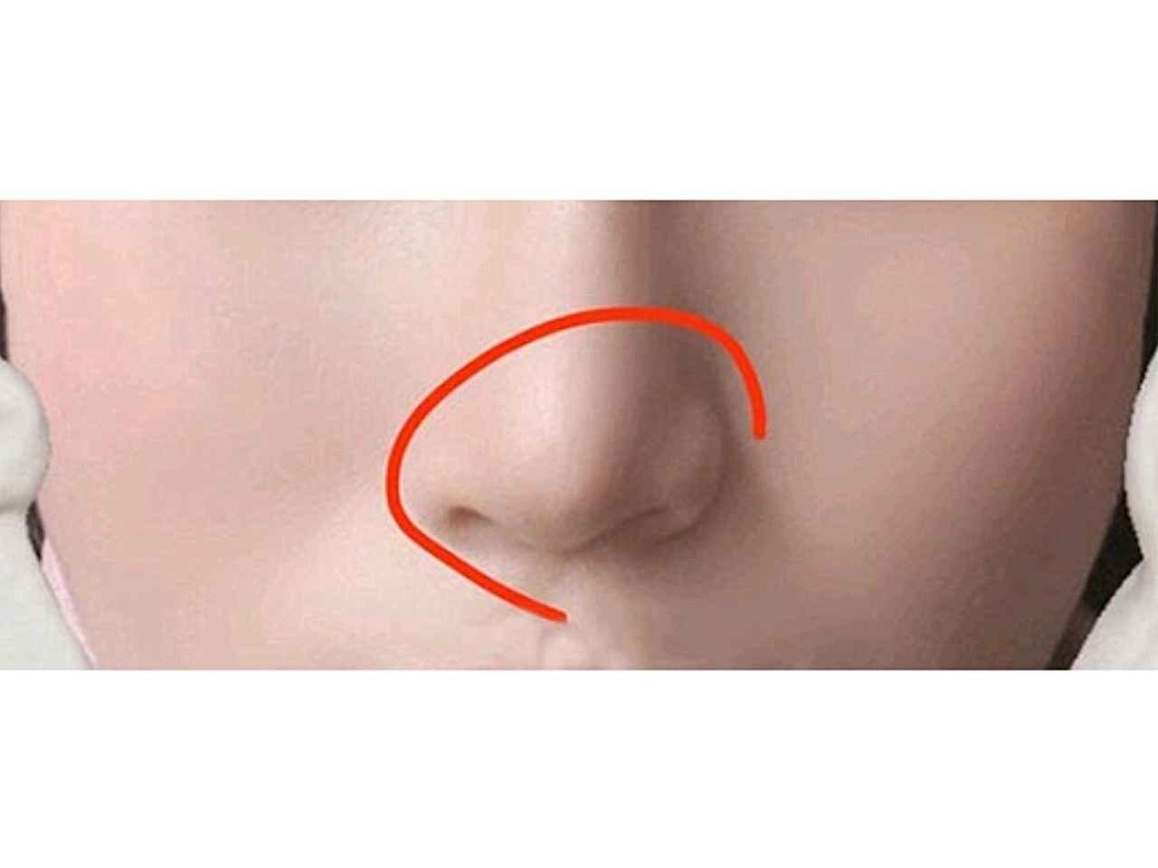 鼻假体下滑图片