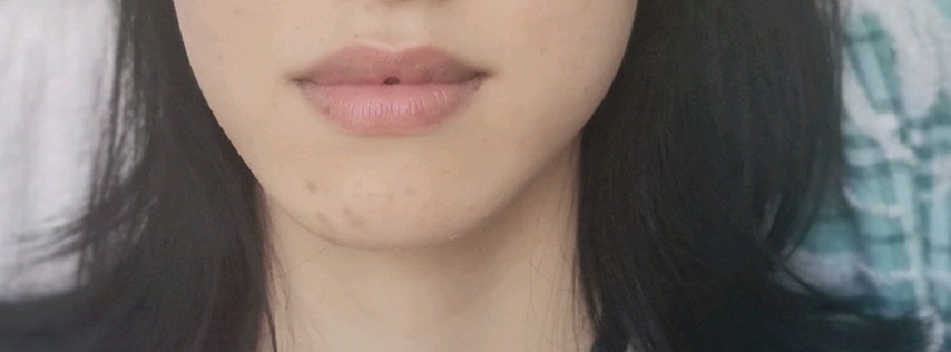 上下唇之间有个小洞,小时候爱撕嘴巴的死皮造成的