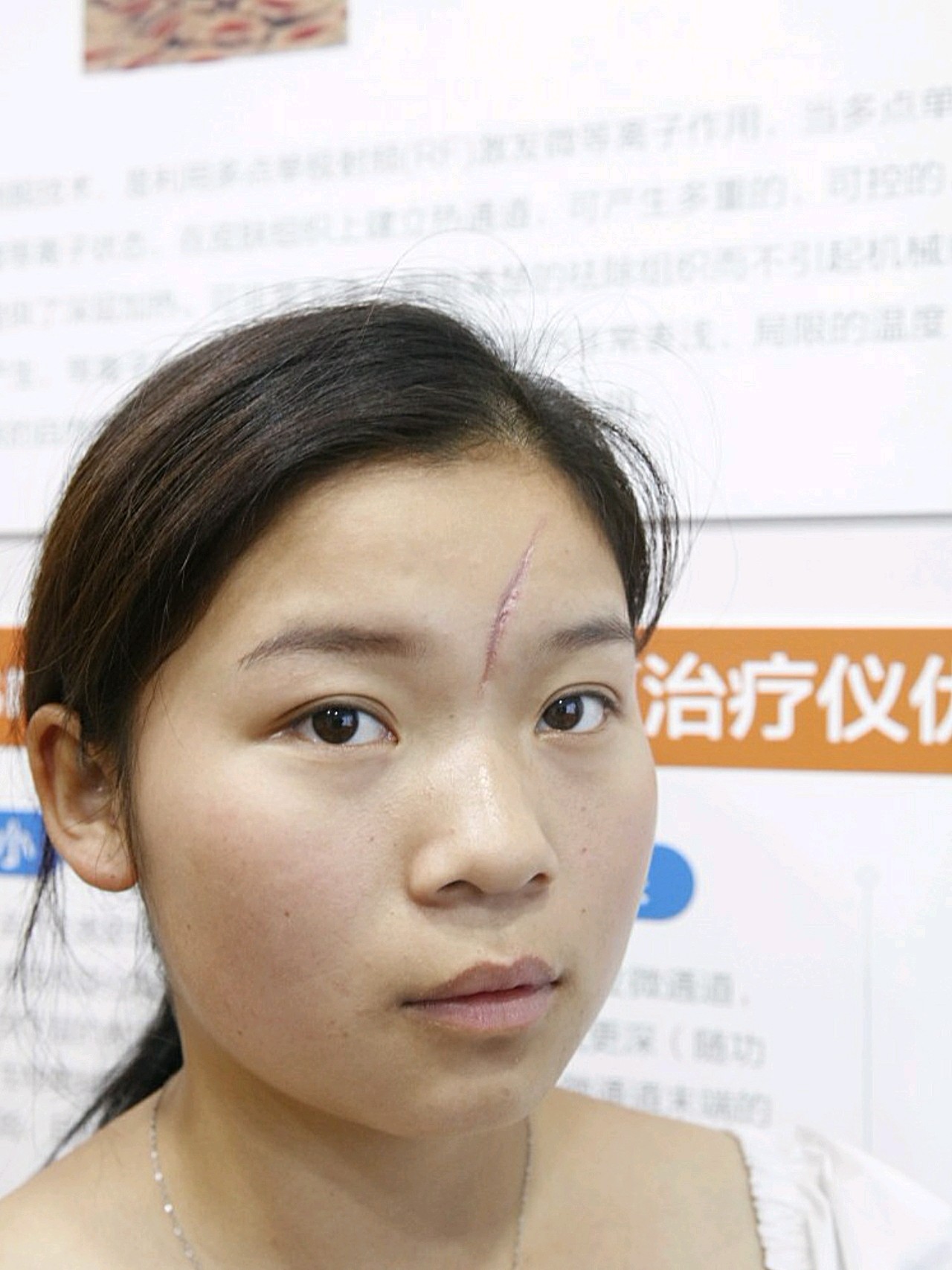 女人图脸上一条疤痕额头有疤长疤痕打球额头撞破了小孩脸上凹陷疤痕