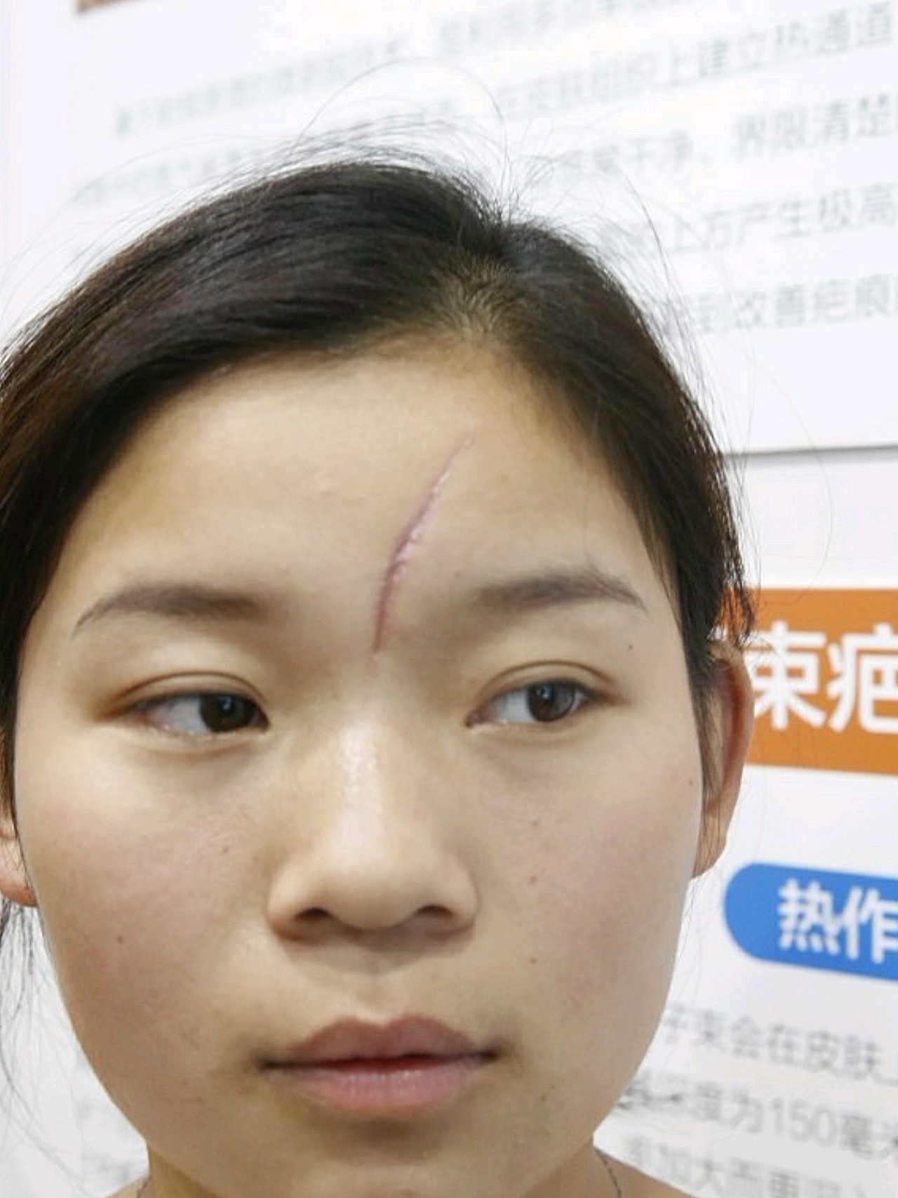 眉中间到额头一条凹陷疤痕横跨很长严重影响着我的外在形象狠狠的伤害