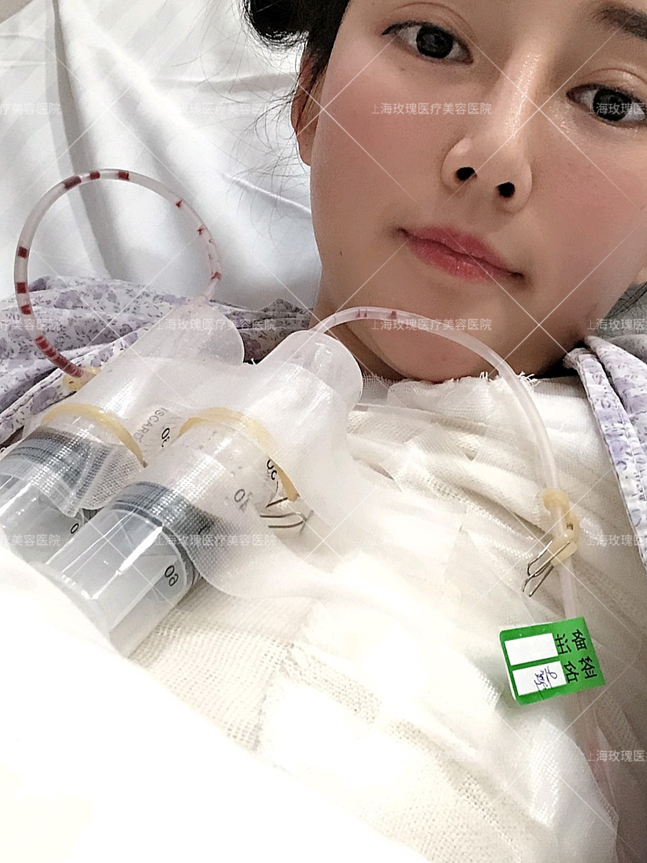 也没人来照顾我,请个护工确实解决了我很多问题,丰胸手术挺成功的