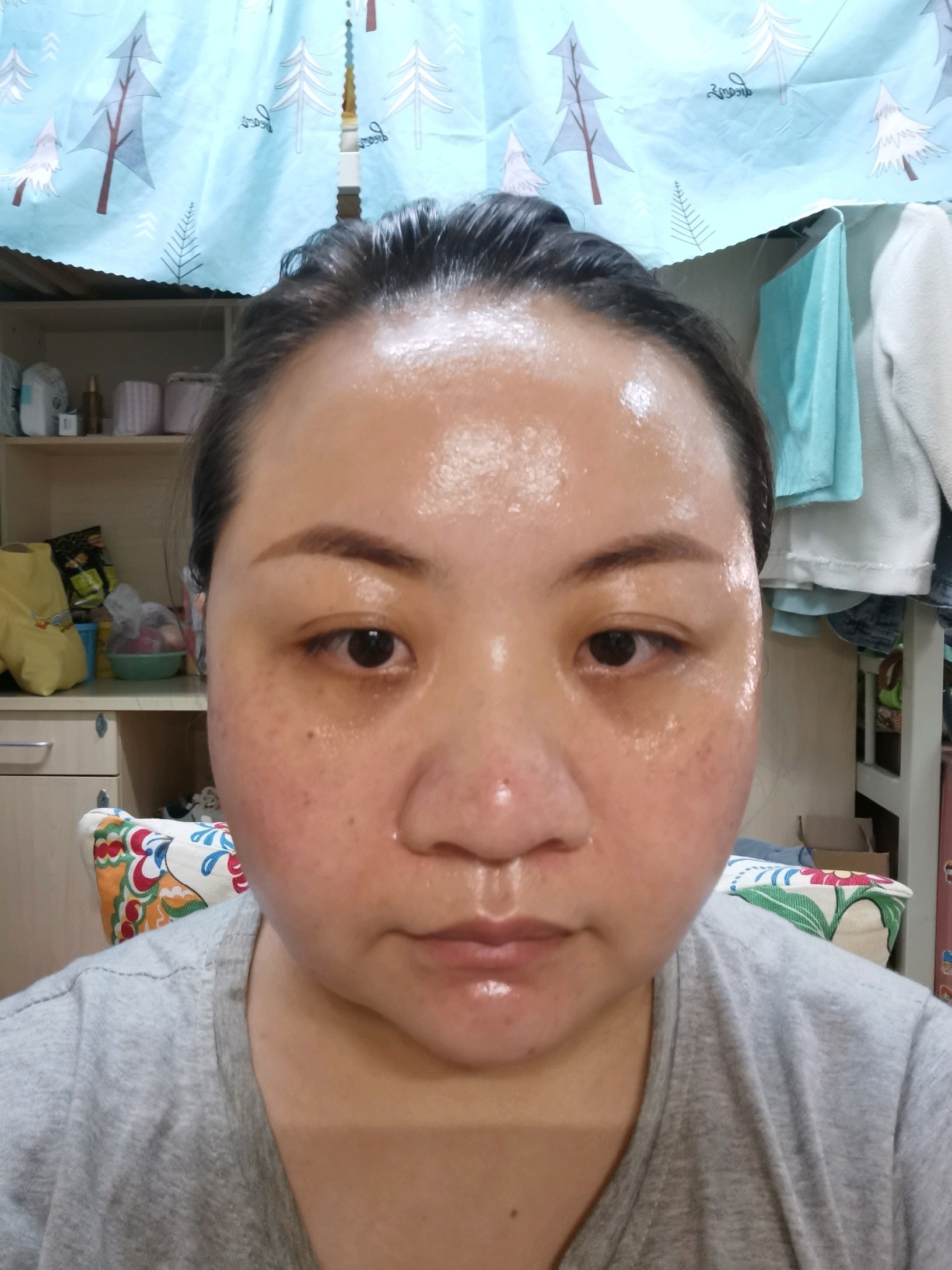刚做完蜂巢皮秒和激光点痣,脸上油光锃亮的98都是护士_圈子-新氧