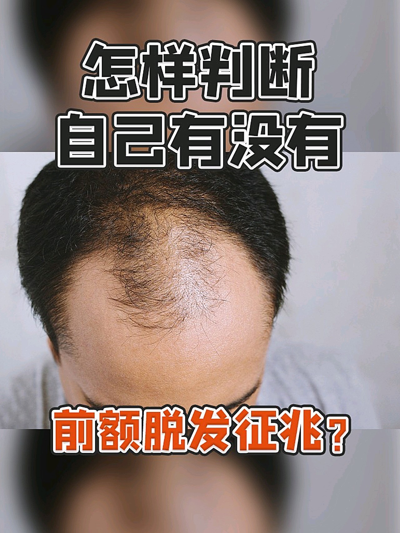 怎样判断自己有没有前额脱发征兆?