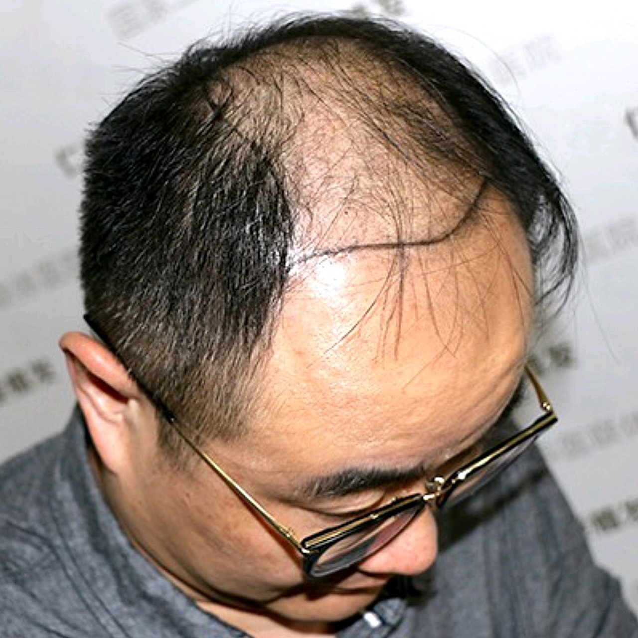 脱发植发:中年人的焦虑来自于成家立业,养家糊口,以及脱发.