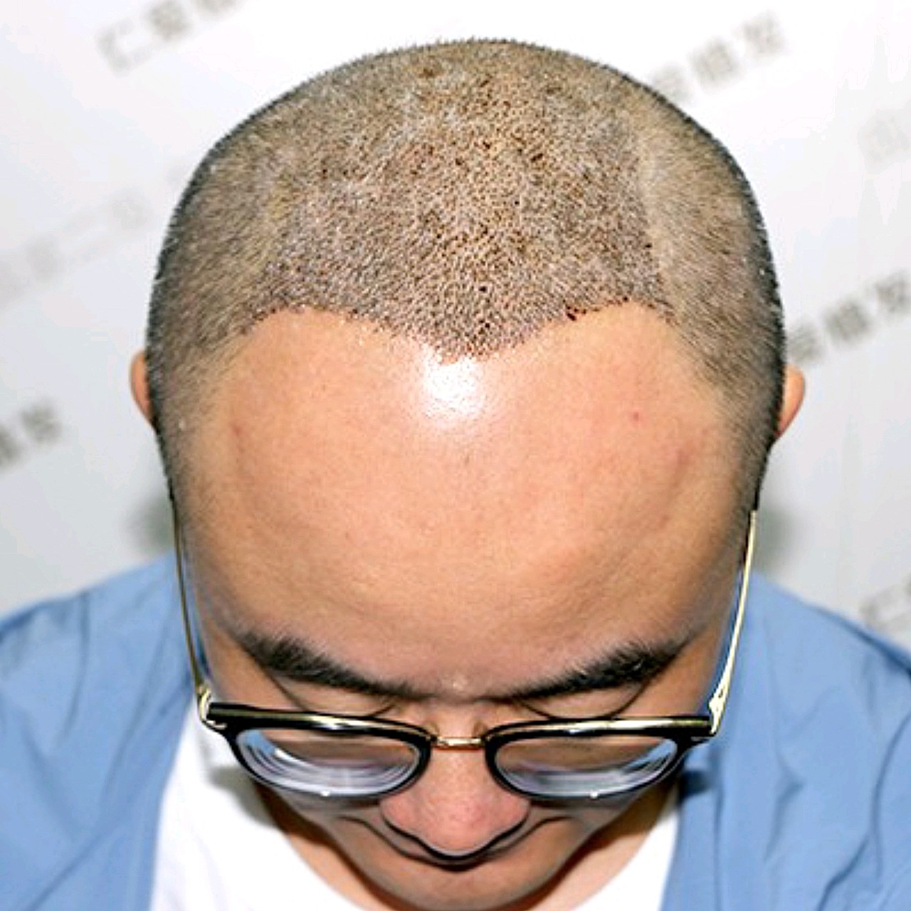 植发第6天,依然打卡报到.