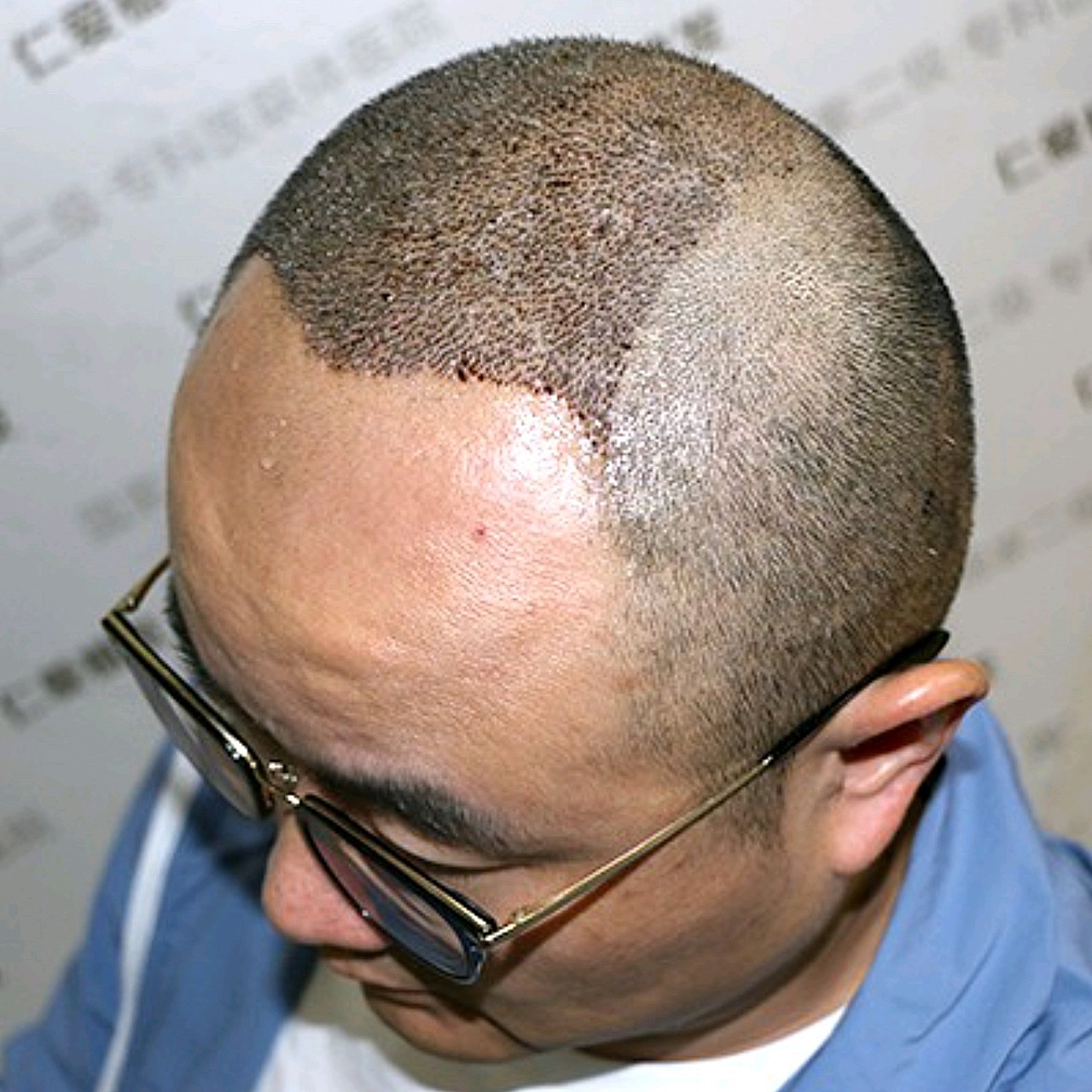 植发分享,蜕变见证,第5天.