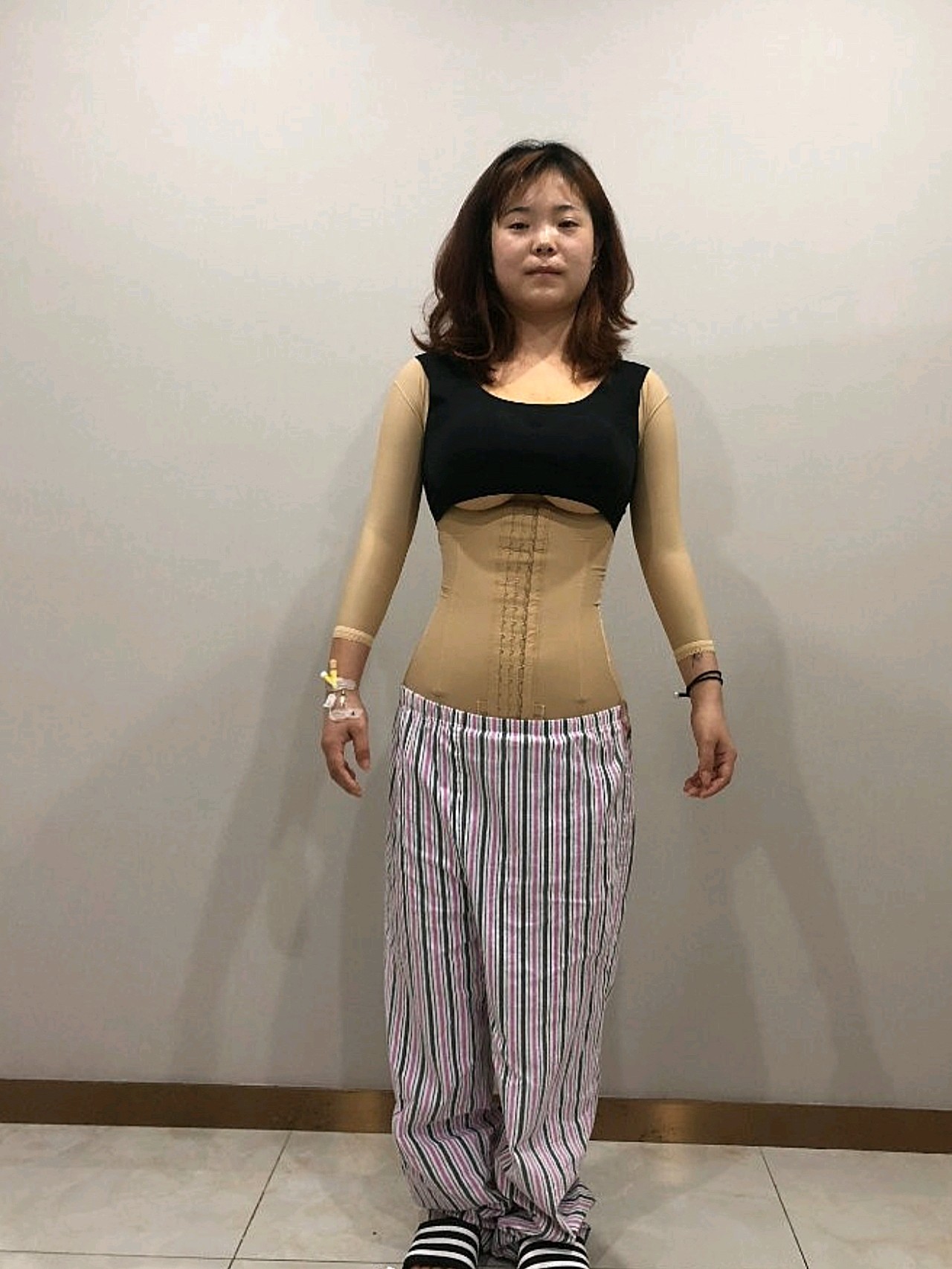 平时老是被周围朋友笑话,说我是大肚腩,这次去做了吸_圈子-新氧美容