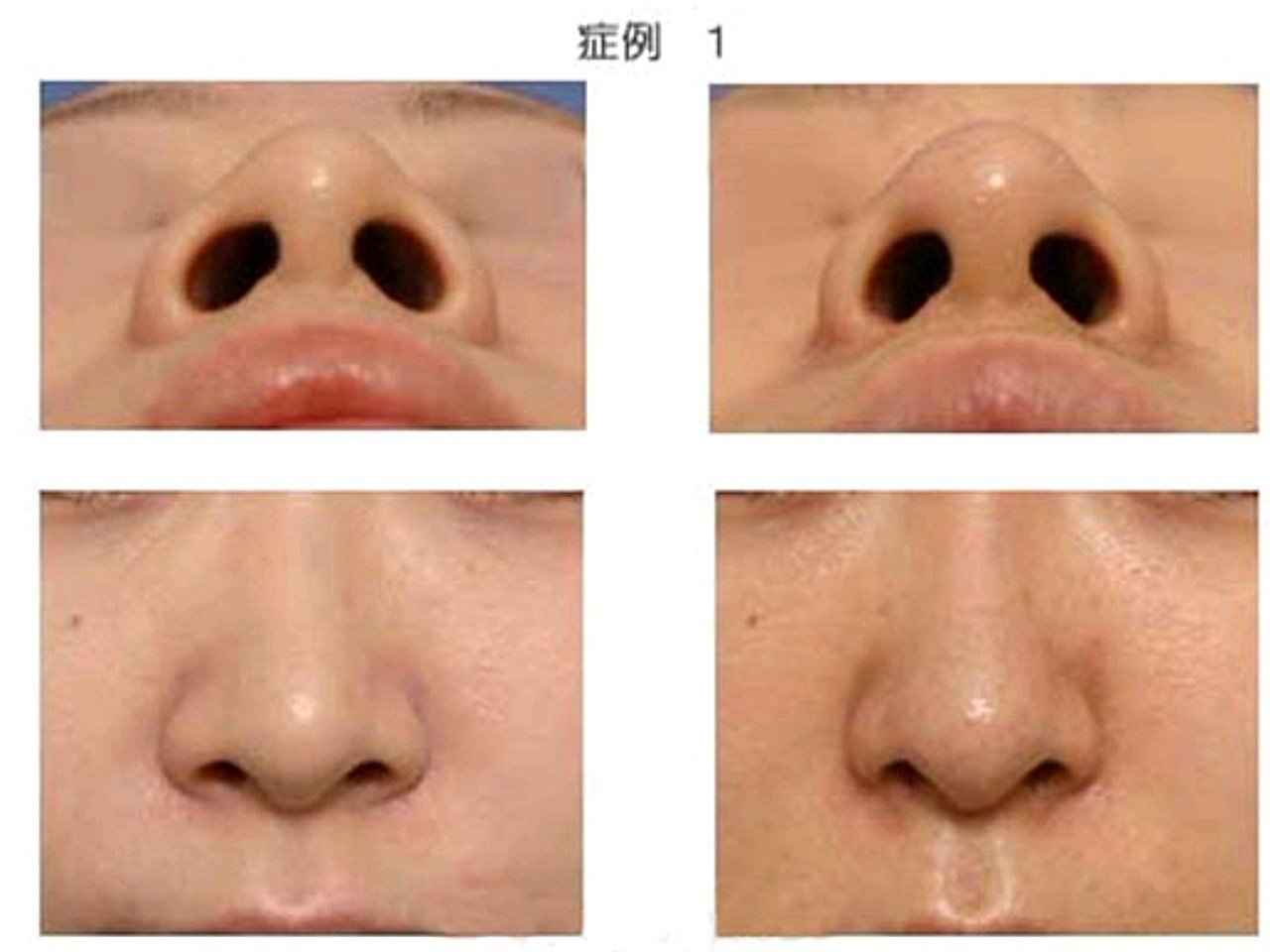 网友提问:医生,缩鼻翼该选择内切还是外切?