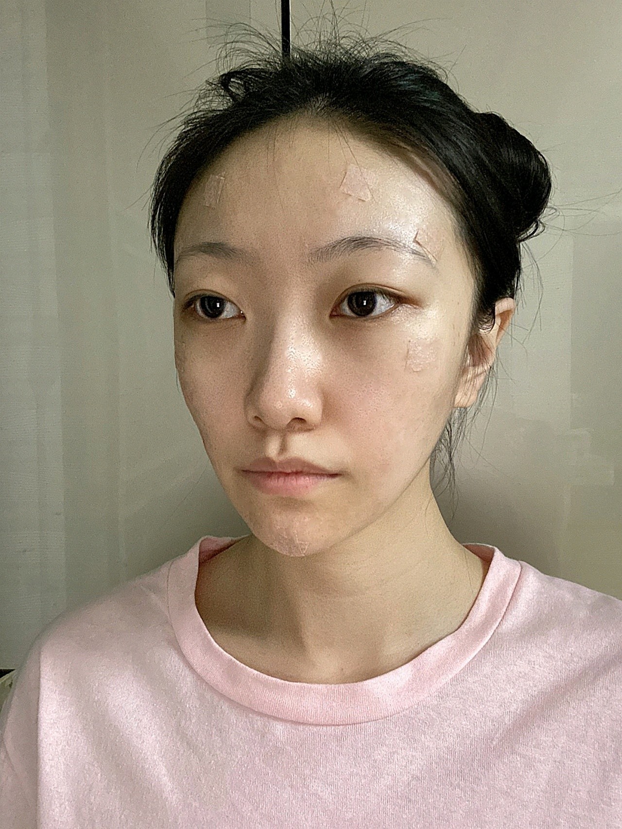【术后第七天】自体脂肪填充术后第七天