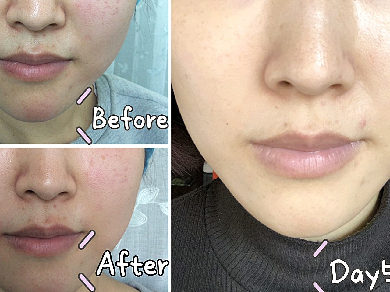 新氧体验官郑州虎珂fotona4d对比效果来啦