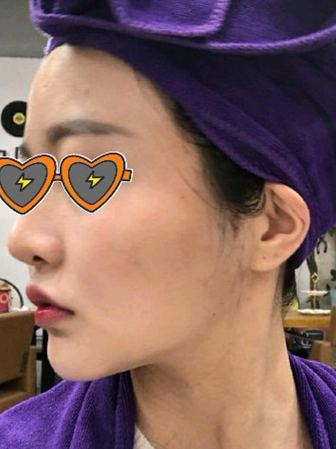 本身颧骨有点高,脸上肉不多,再加上下巴短,我真的_圈子-新氧美容整形