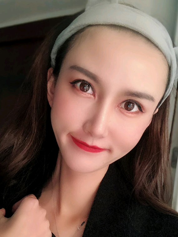 2个月了,自从做了脂肪填充了,脸部饱满了,颜值重回_圈子-新氧美容整形