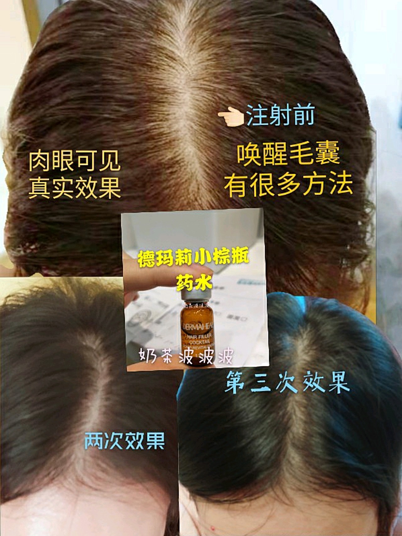 头发浓密发际线完美的集美们,我带着激动的心情来给你们做反馈中胚层