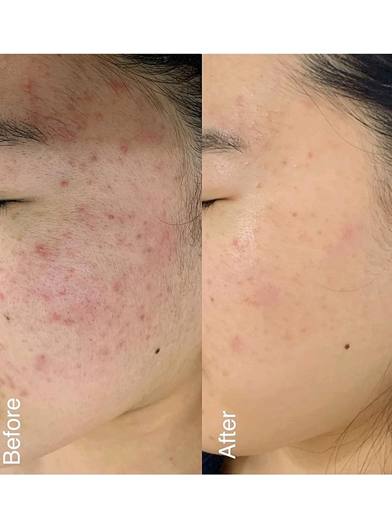 私藏生理盐水蒸馏水湿敷法 痘痘闭口全拜拜!