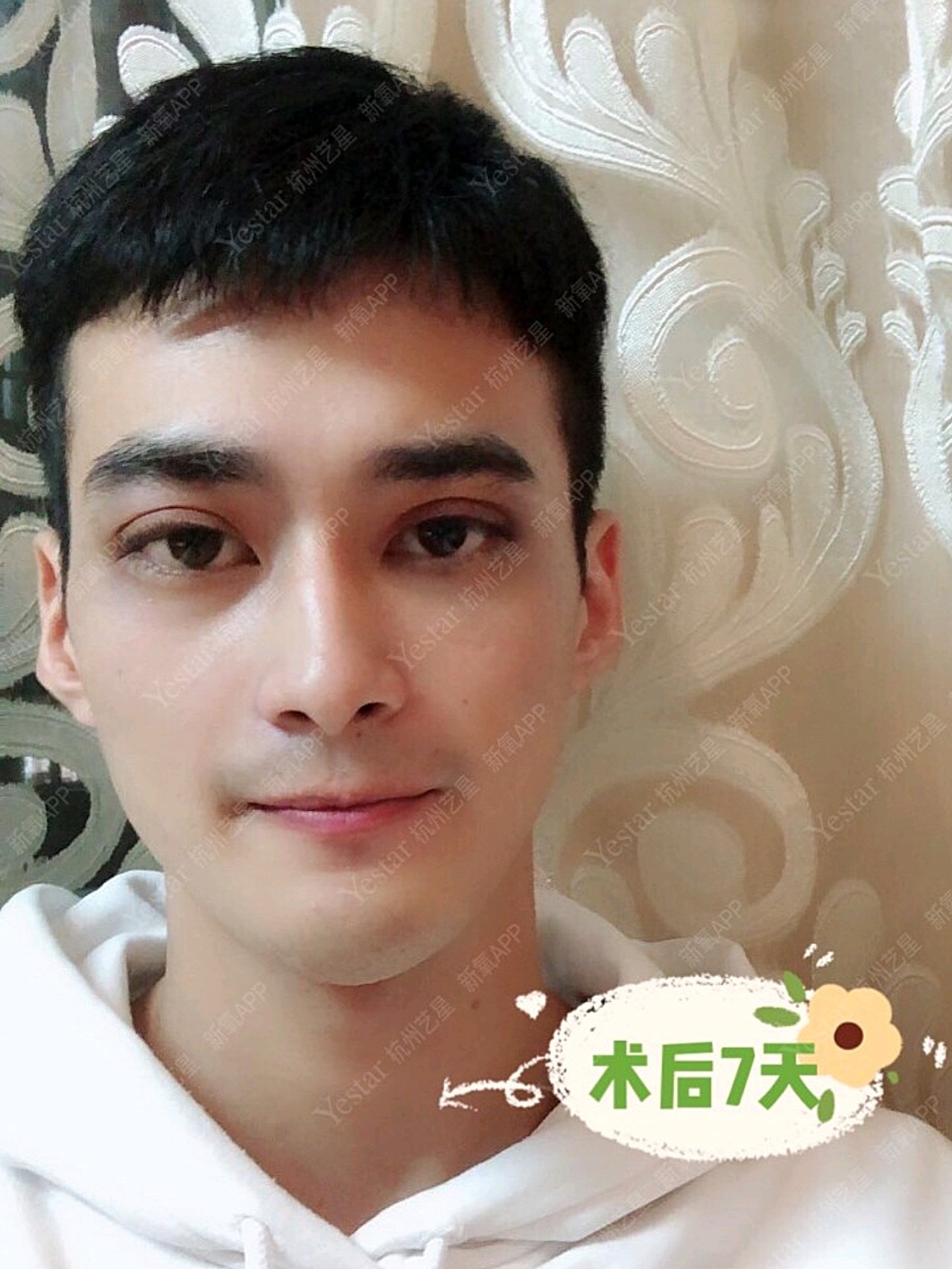 【案例分享】男生割双眼皮与女生会有不同吗