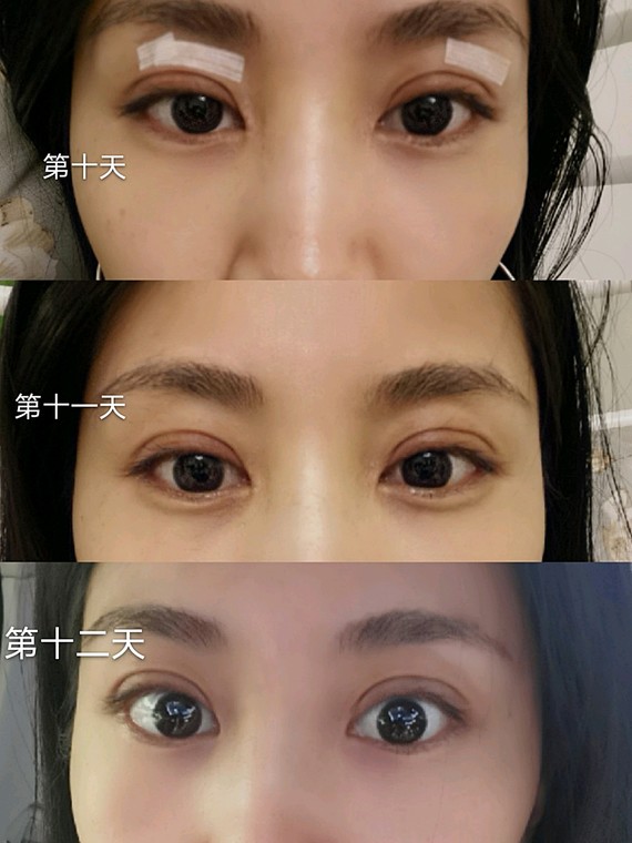 全切双眼皮 开眼角 上眼睑脂肪填充