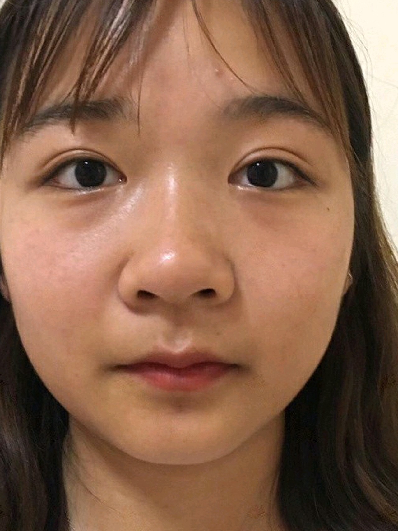 鼻翼缩小后都夸变可爱了