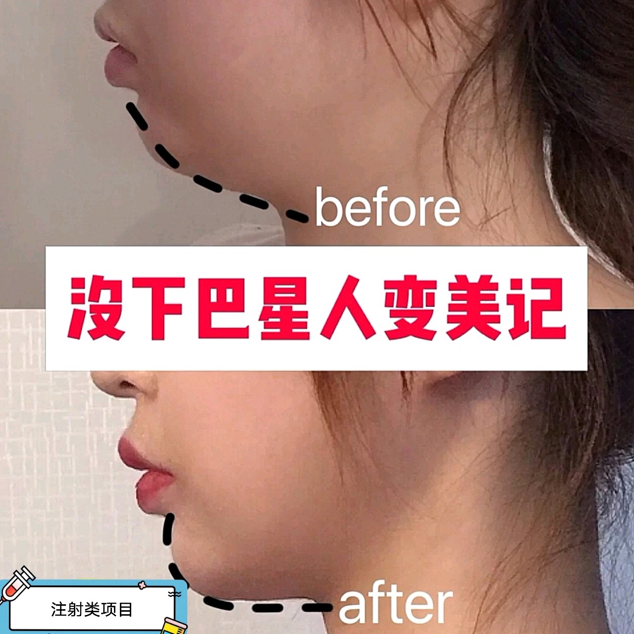 本人下巴比较短,侧面看真的非常的显脸圆,还有点呆呆_圈子-新氧美容