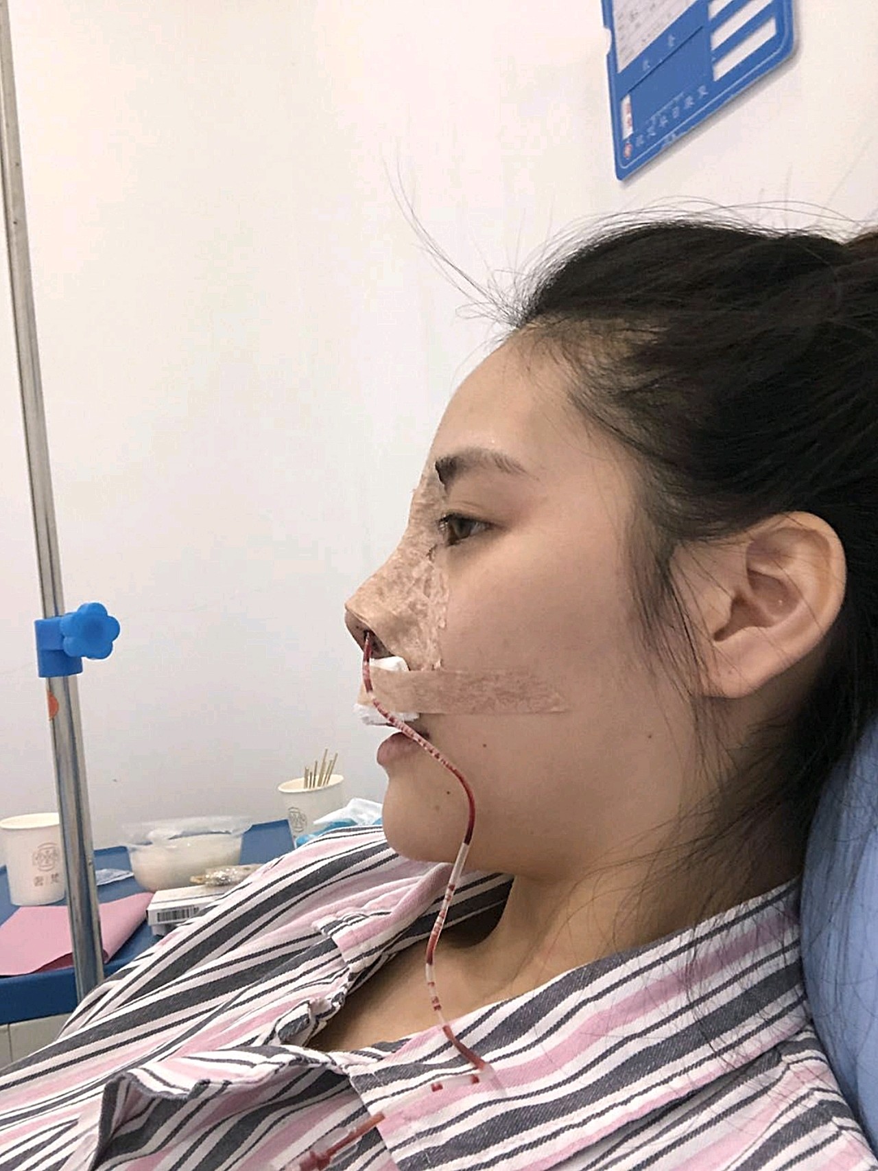 膨体隆鼻术后第一天