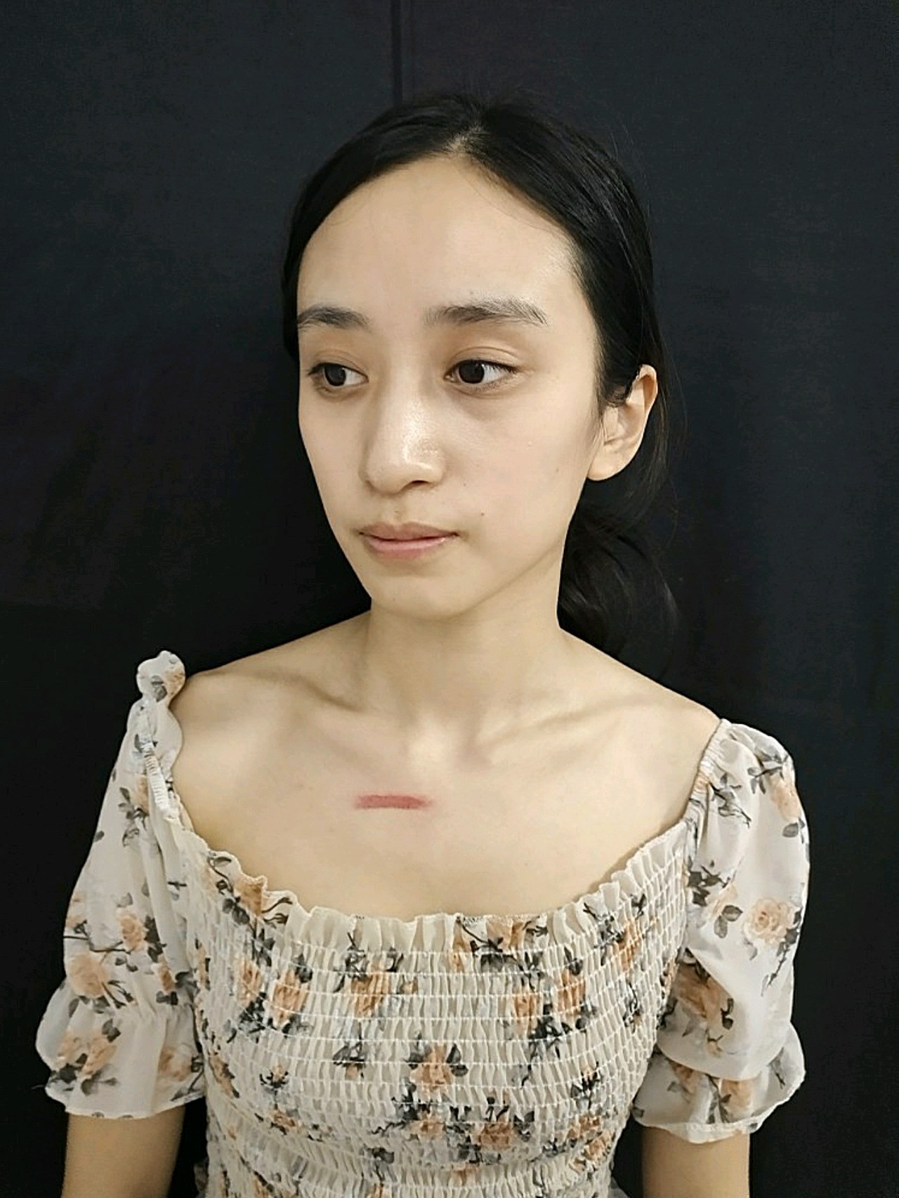 我这个借助的是离子束来修复疤痕的,针对我这种扁平疤_圈子-新氧美容