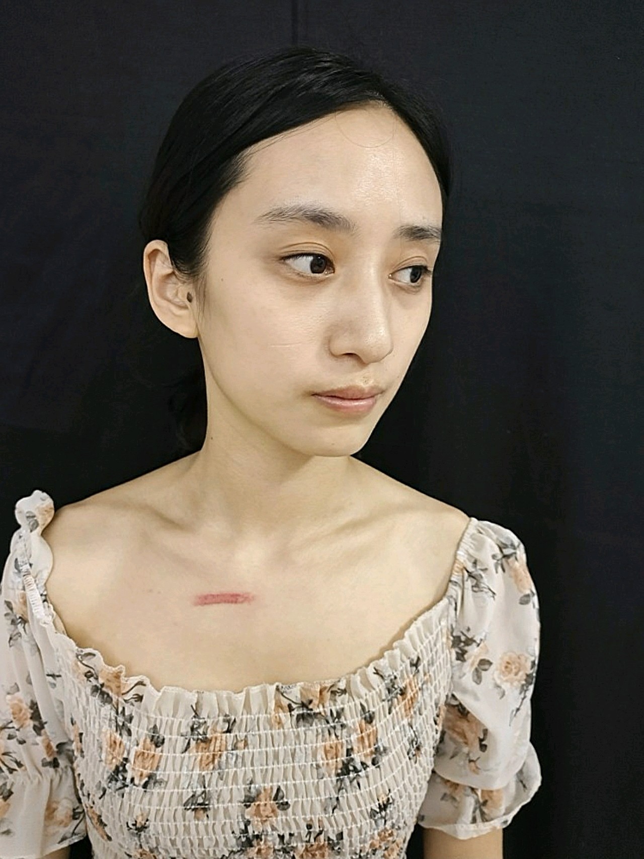 我这个借助的是离子束来修复疤痕的,针对我这种扁平疤_圈子-新氧美容