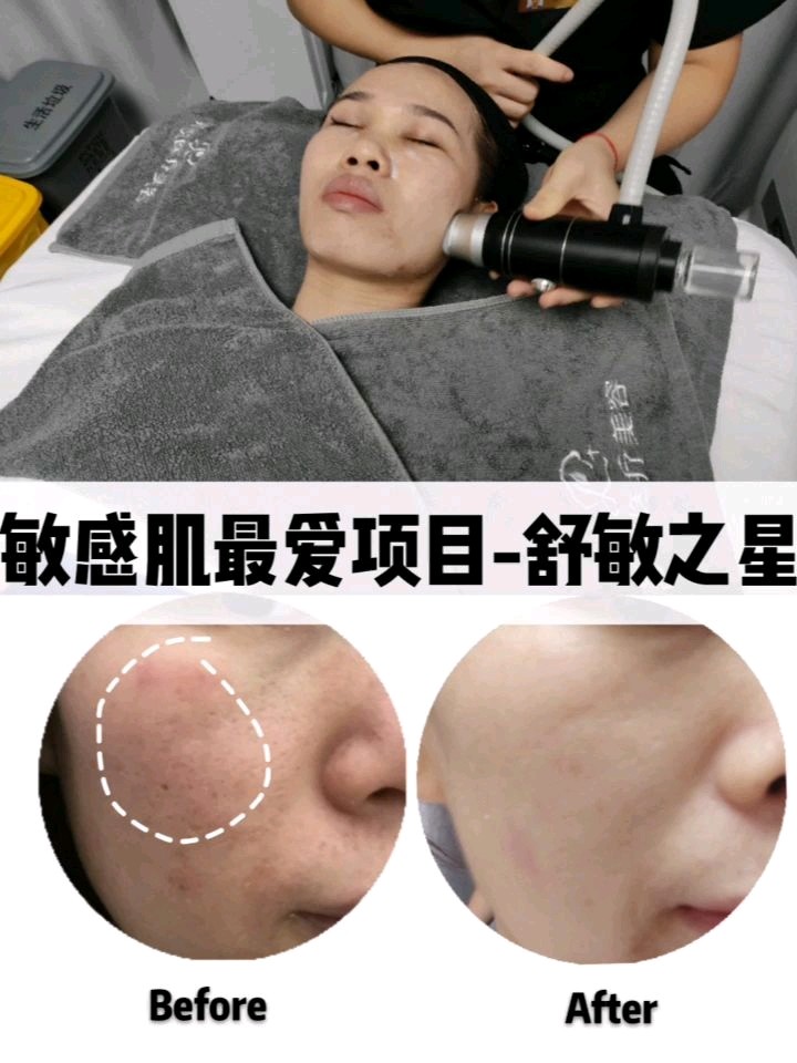 作为敏感肌我最爱的项目就是舒敏之星82解决换机过敏干燥泛红超级有