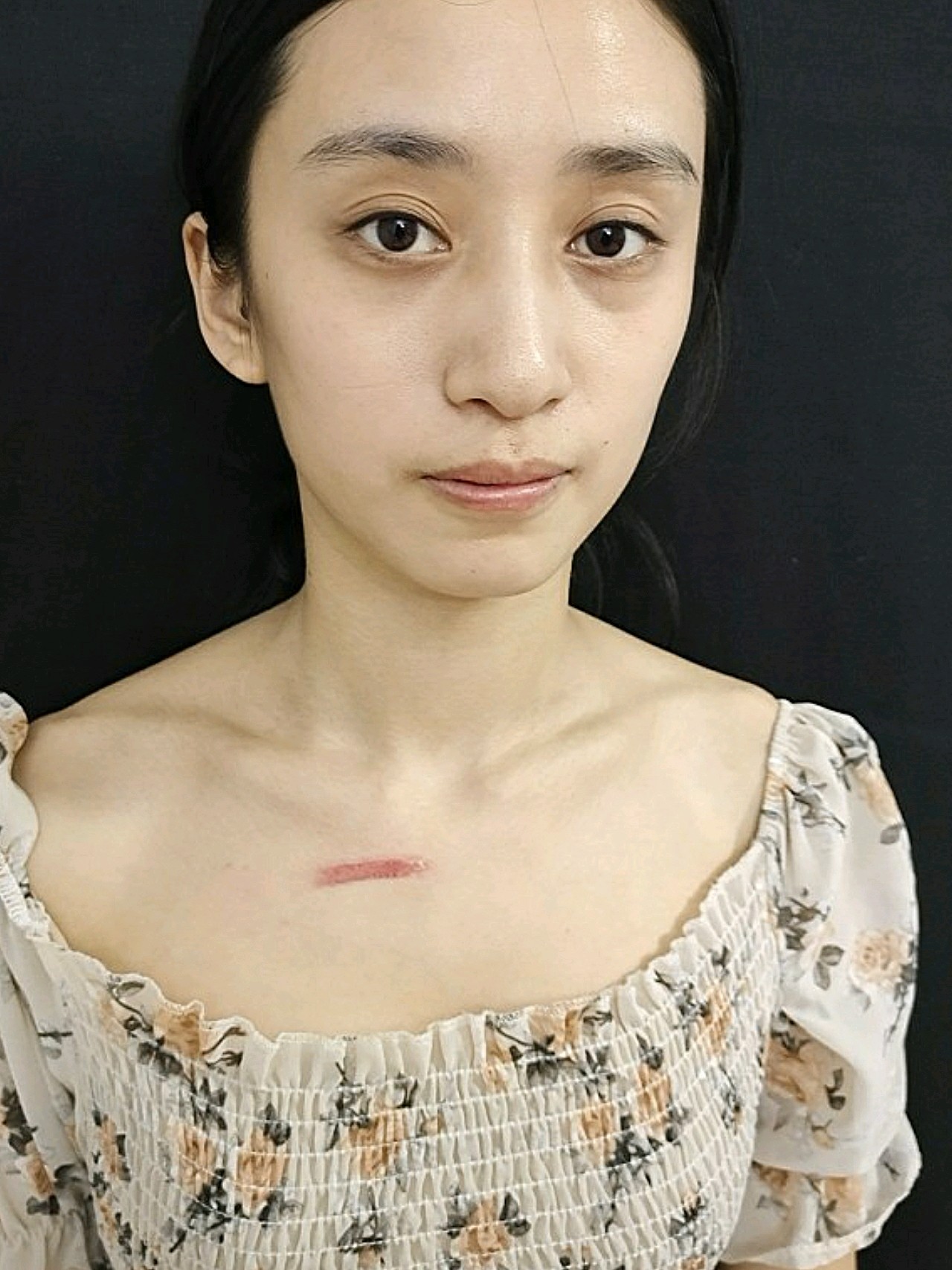 我这个借助的是离子束来修复疤痕的,针对我这种扁平疤_圈子-新氧美容