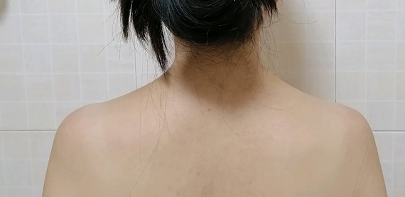 淤青看不到了,但是针眼还可见,肩膀酸困加剧,有无力感,但不痛.
