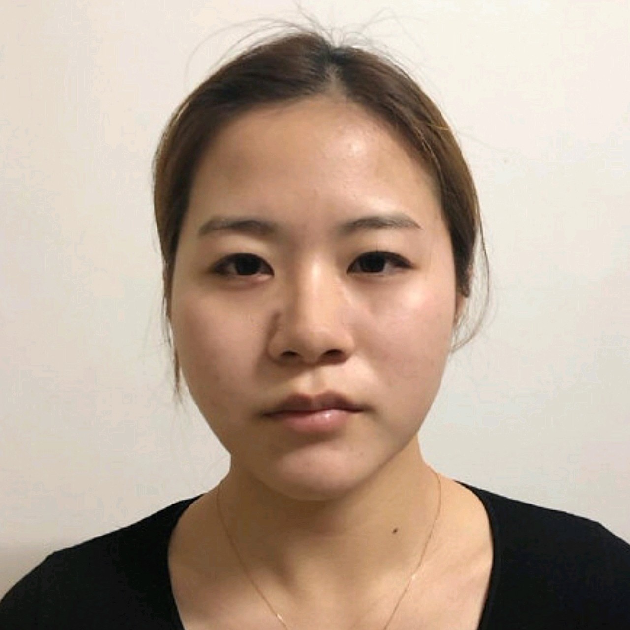 抽掉多余脂肪厚,脸变尖了,而且下颌缘线条清晰.