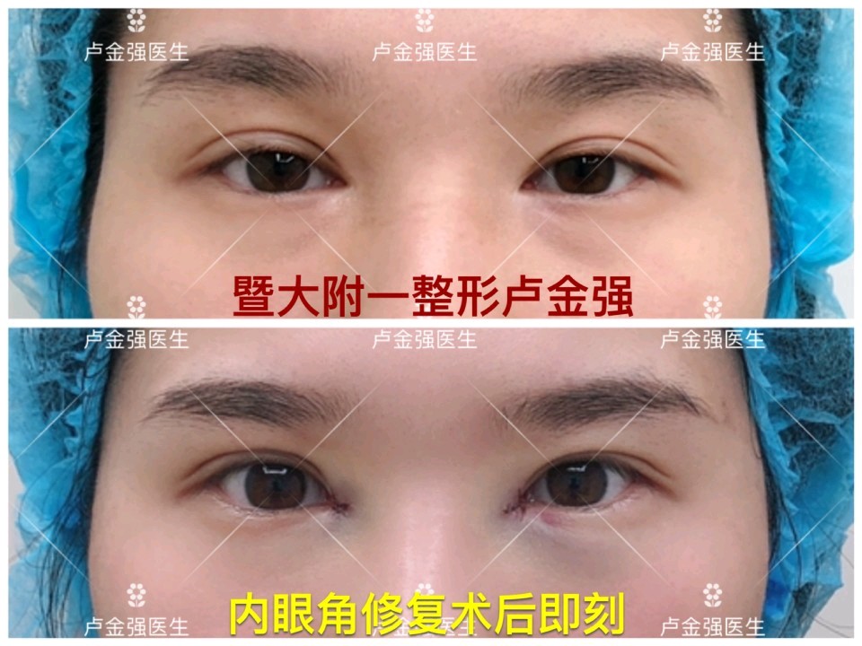 内眼角修复案例