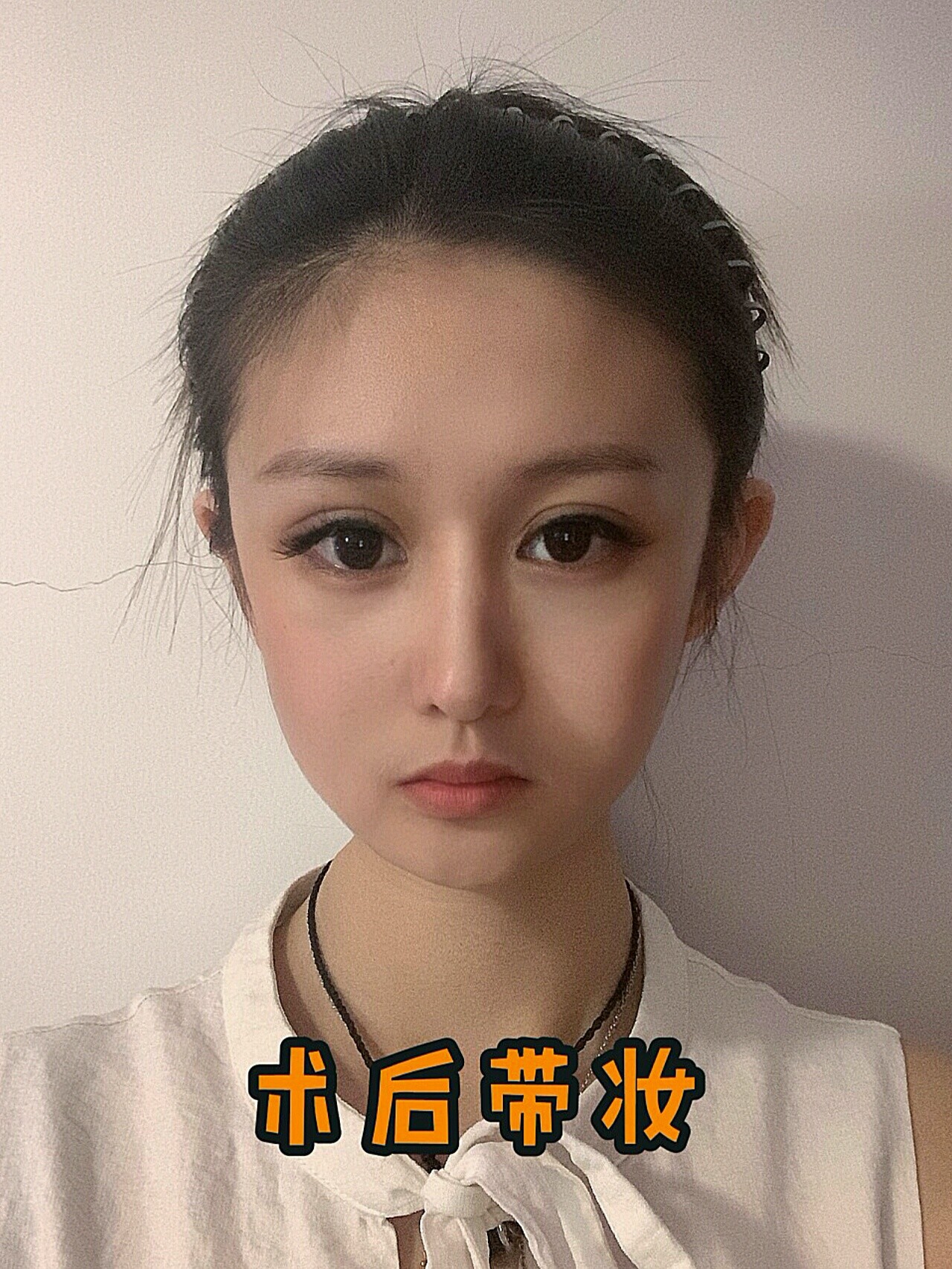 97蒜头鼻 肉鼻头 _圈子-新氧美容整形