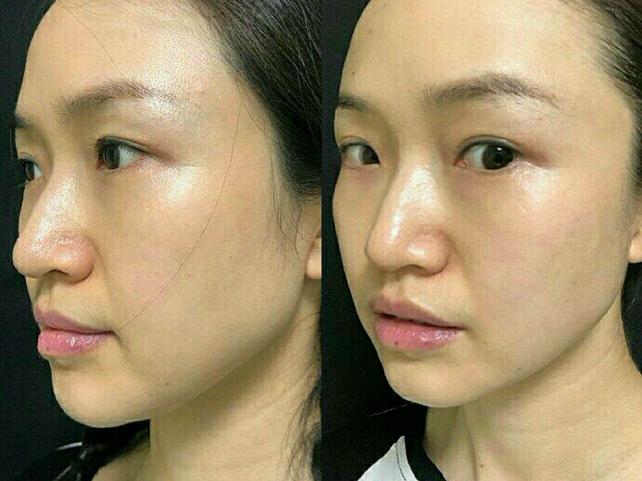 不知不觉已经一个月过去了,热玛吉的效果还在,对比之_圈子-新氧美容