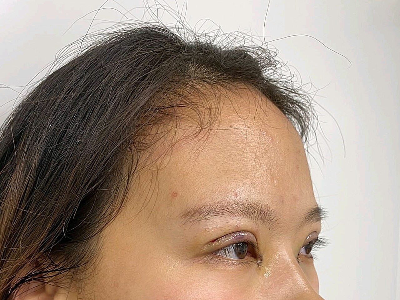 准备回去,术后感觉也没有很痛,就是肿胀吧,终于了了想割眼睛的心愿了
