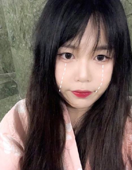 之前是单眼皮,而且上眼皮很厚重,看起来像死鱼泡眼