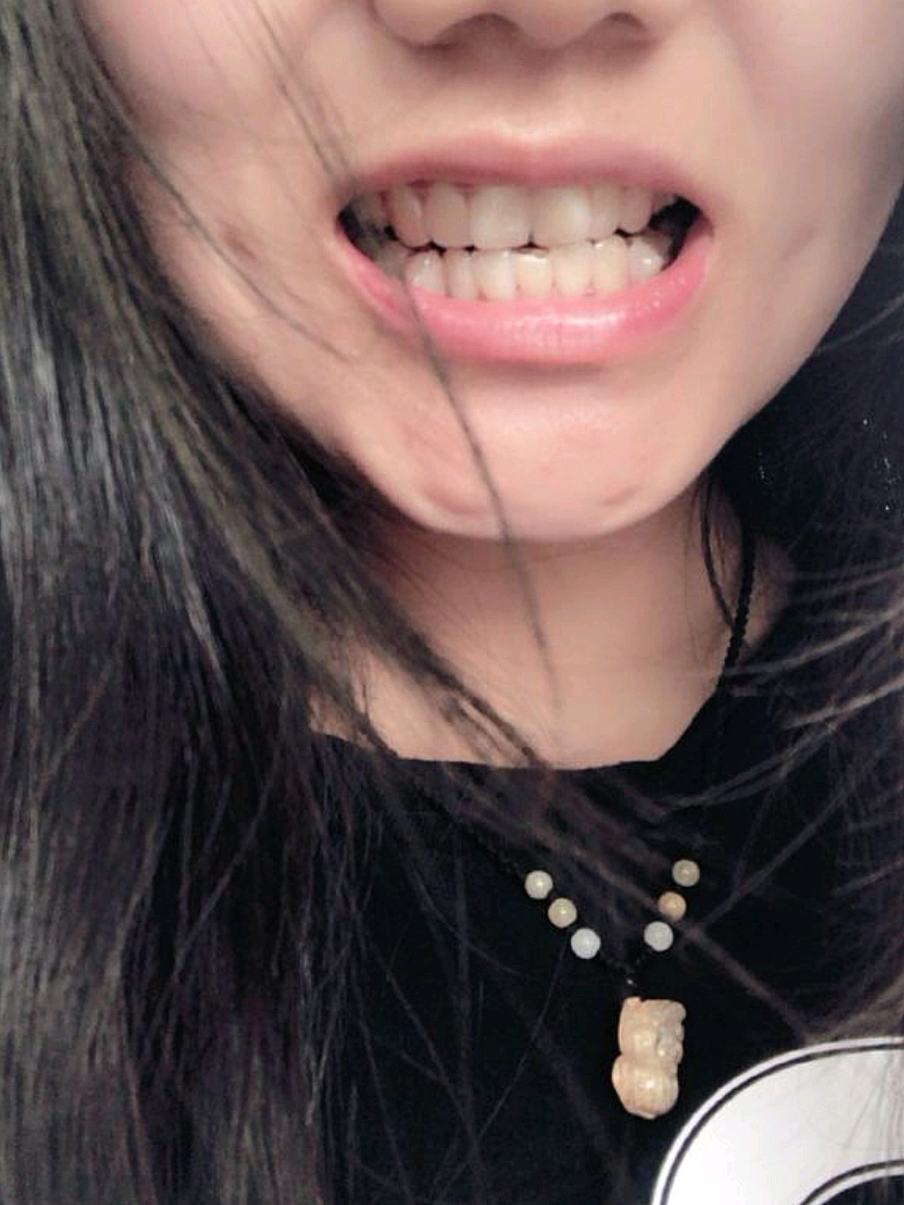 这是我的牙齿深覆合门牙歪曲下牙缺失一颗牙所以不齐底下还长了一颗