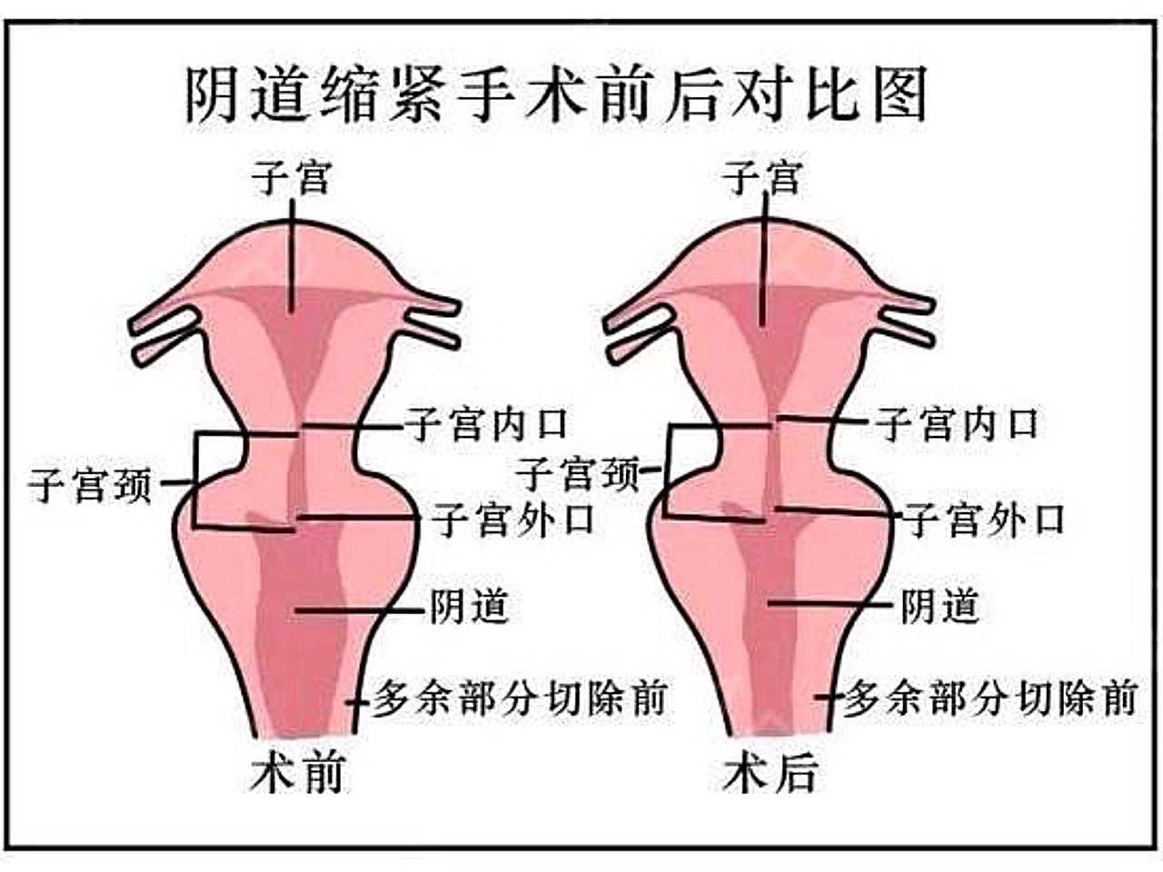 宫颈口紧图片