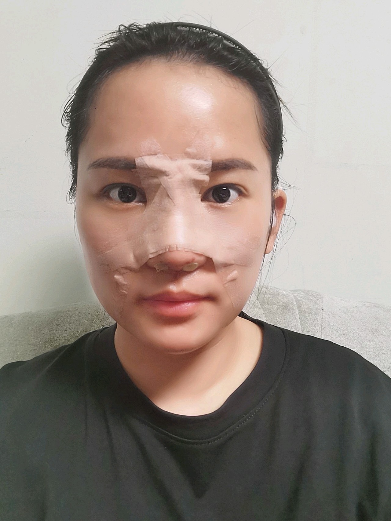 项目:【膨体隆鼻术后第一天】