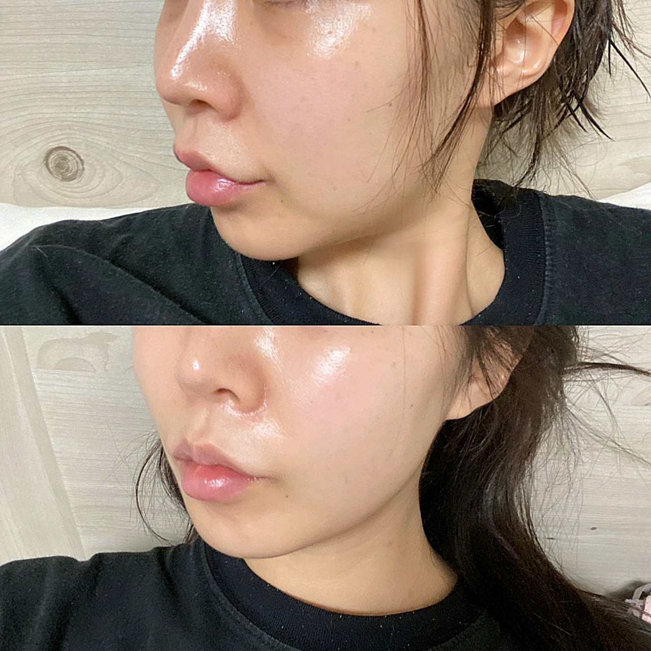 面吸前后对比,效果太明显了,脸上的肉不见了,轮廓出_圈子-新氧美容