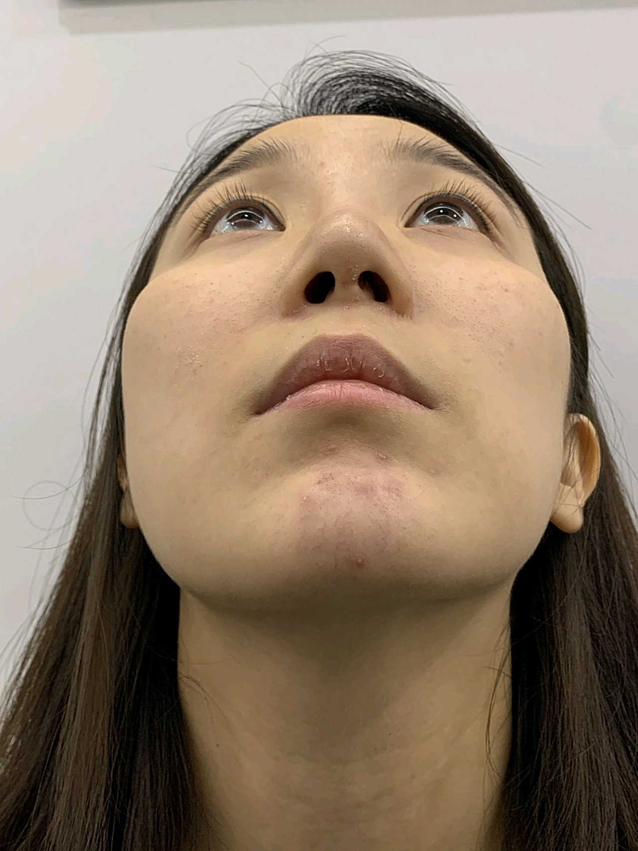 这鼻子感觉做了当没做一样,还是这么塌没有山根,鼻背_圈子-新氧美容