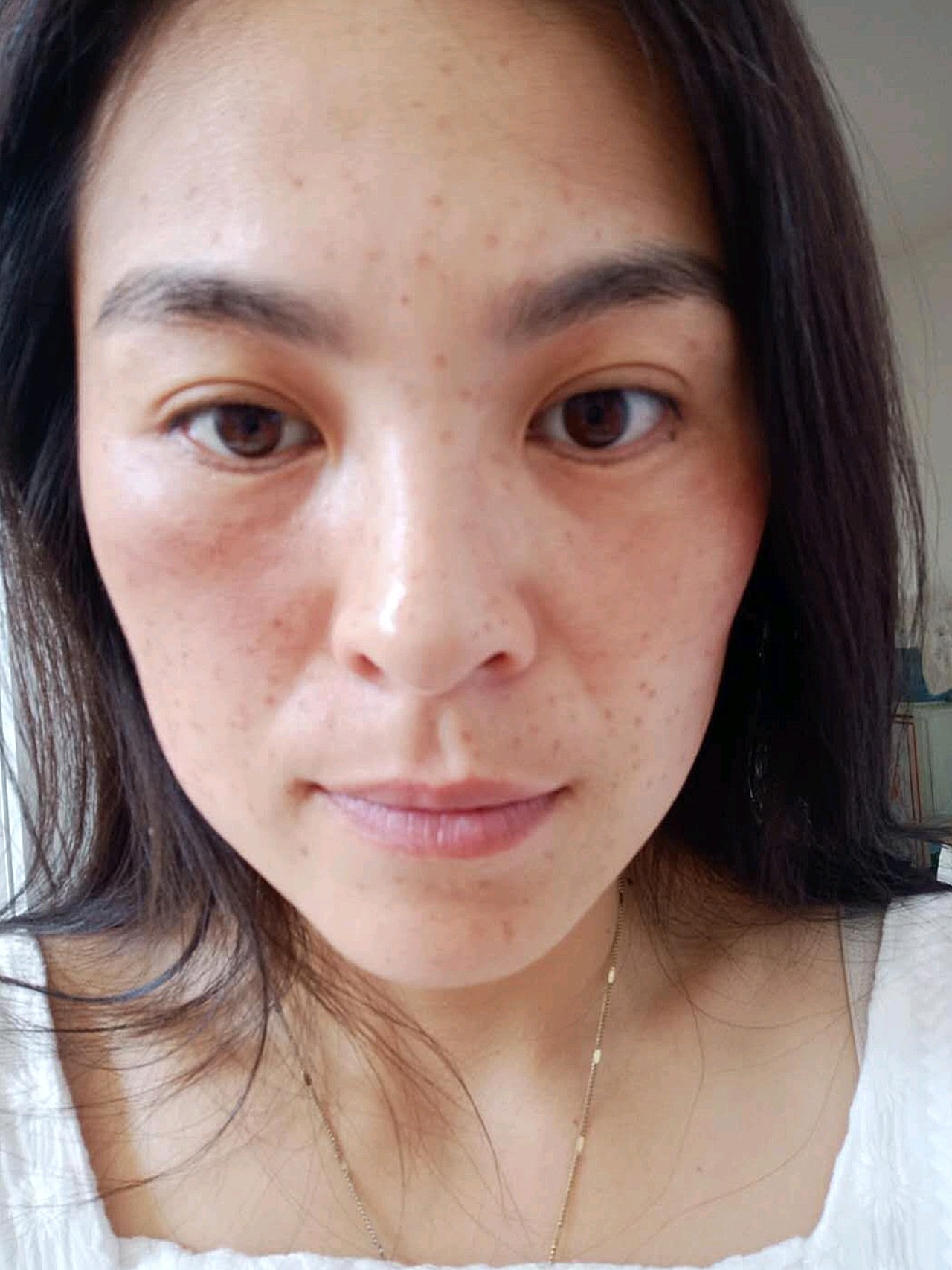 祛斑对比图 十几岁就有斑生了孩子越长越多 祛斑皮秒激光都做过反弹更