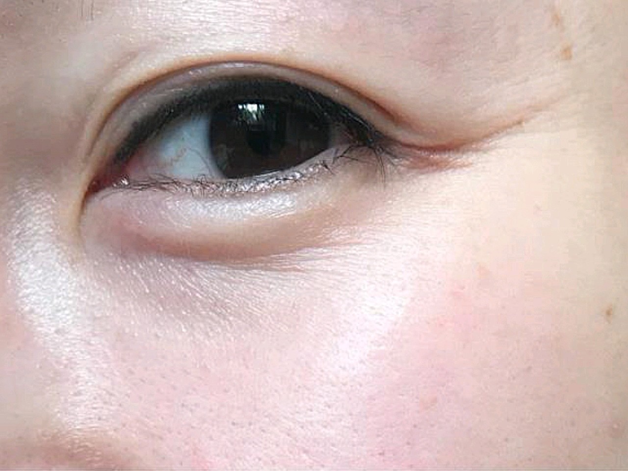 一个多星期了,眼尾动态纹笑的时候没有了,好开心,效_圈子-新氧美容