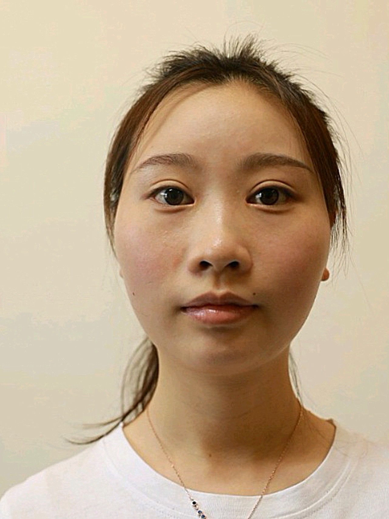 【玻尿酸丰下巴,鼻基底术后第15天】