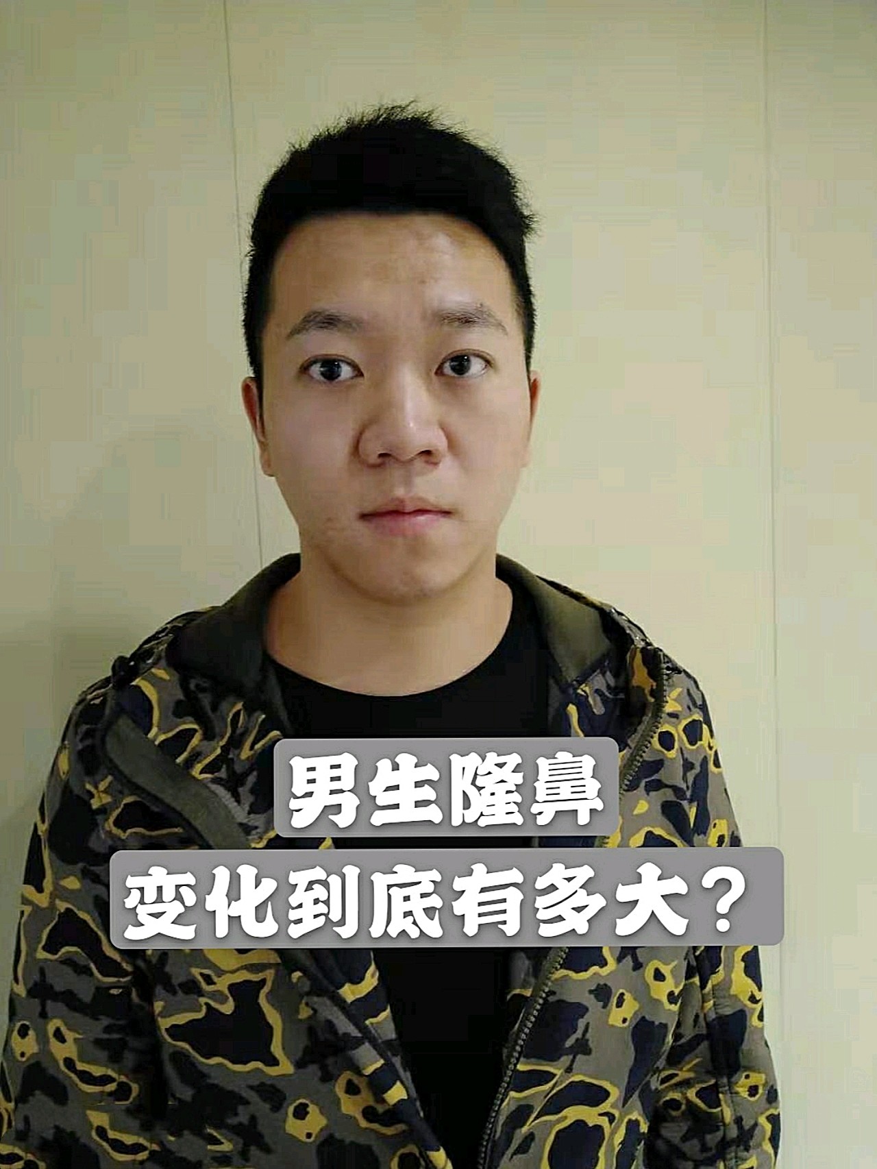 【男生隆鼻变化到底有多大?】