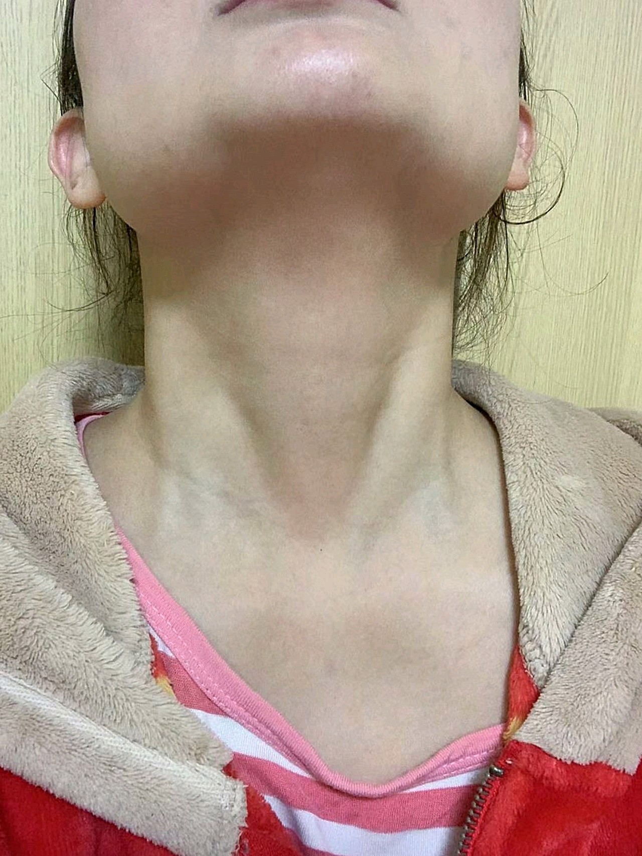 这几天脖子上面的颈纹真的好很多,感觉都没有颈纹了是_圈子-新氧美容