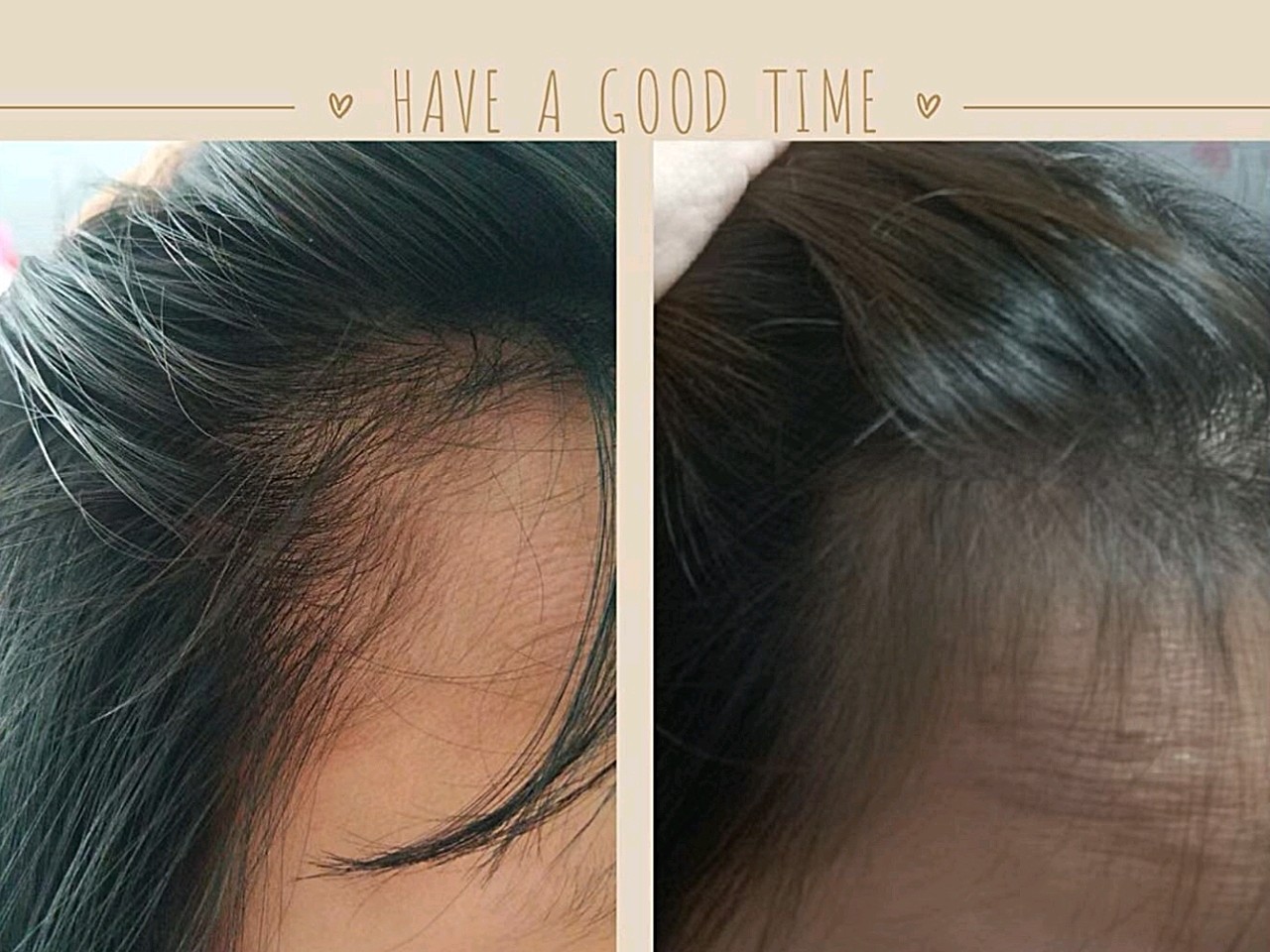 发际线种植day140,发际线长出小小的绒毛啦,开心开心,是我想要