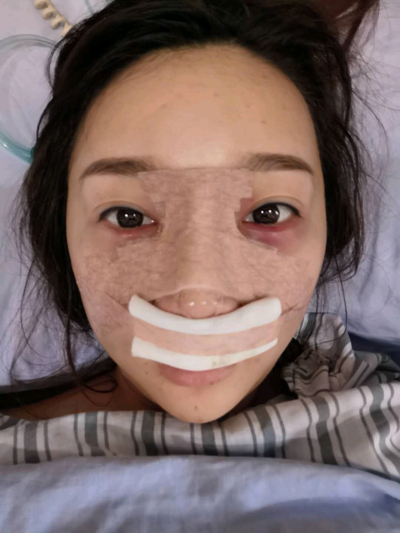 注射整形鼻子价格多少_注射隆鼻整形手术费用_鼻子注射整形价格