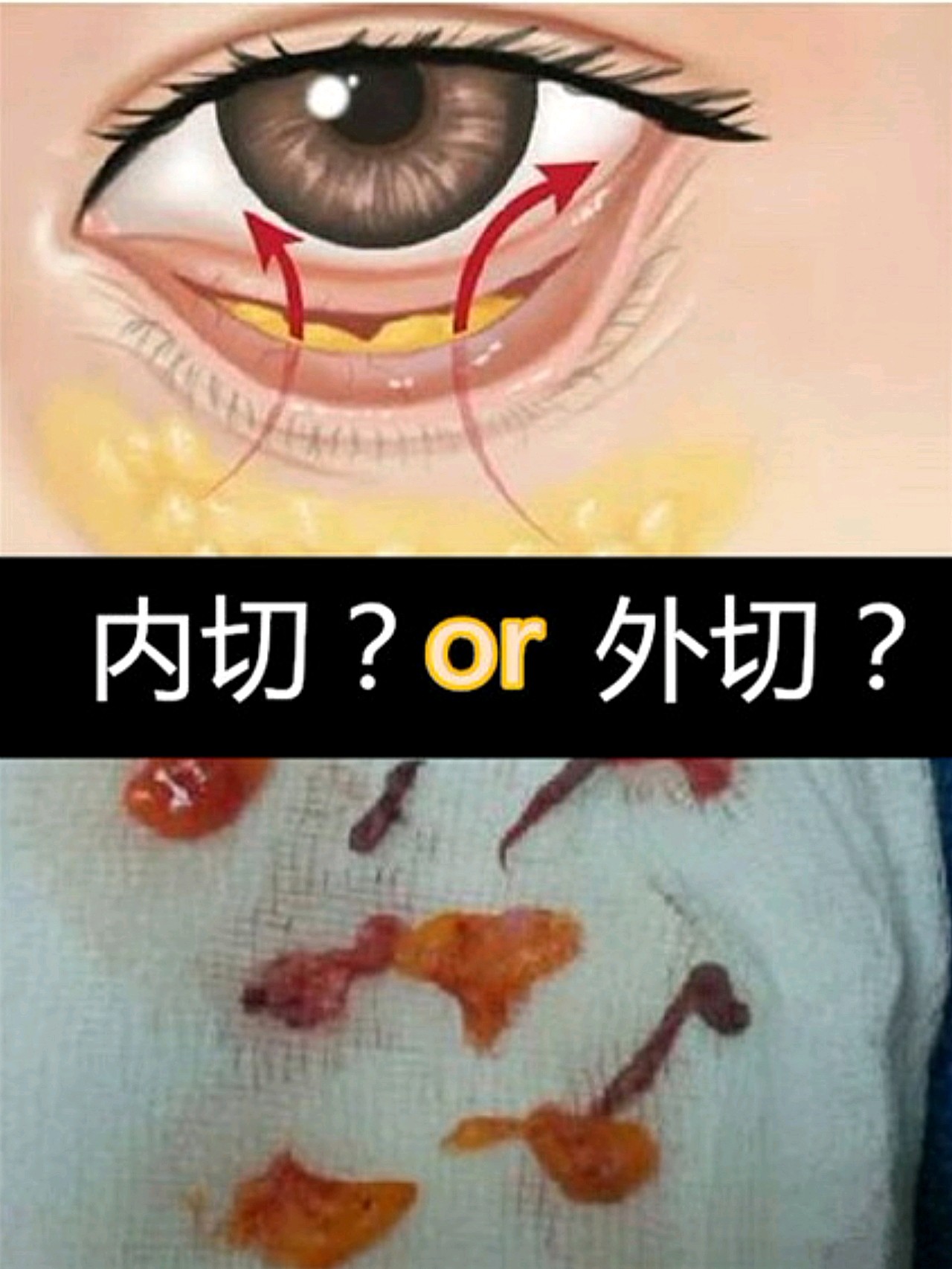 眼袋是內切好還是外切好?