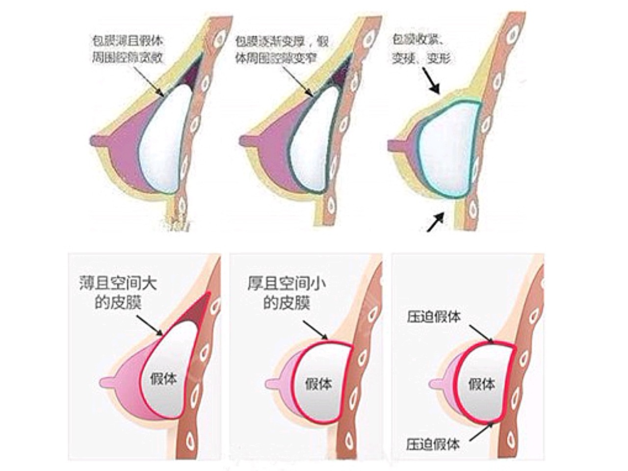 多数女性,包膜包裹假体但不会过度挤压假体.