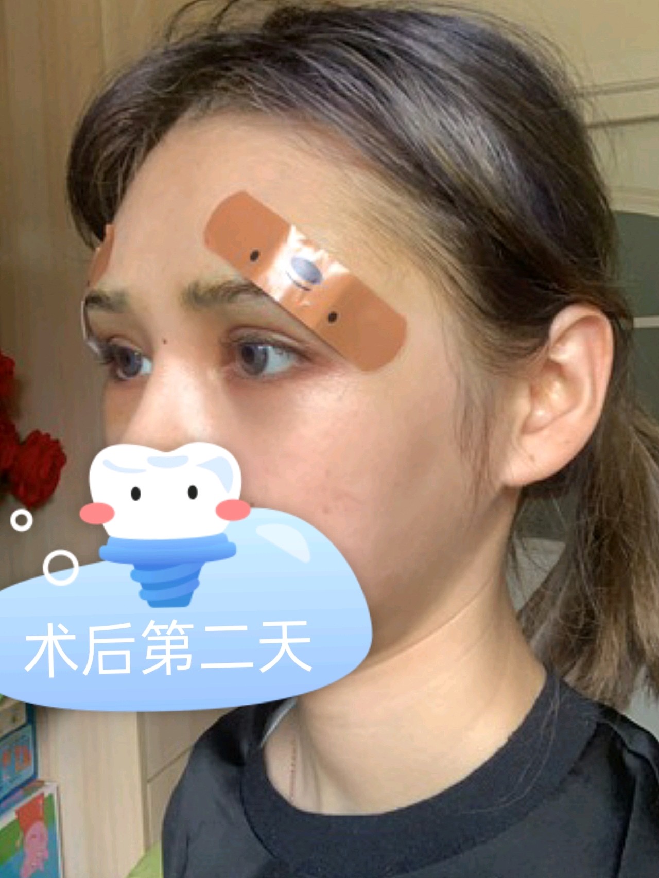 眉弓手术第二天肿成熊猫眼了